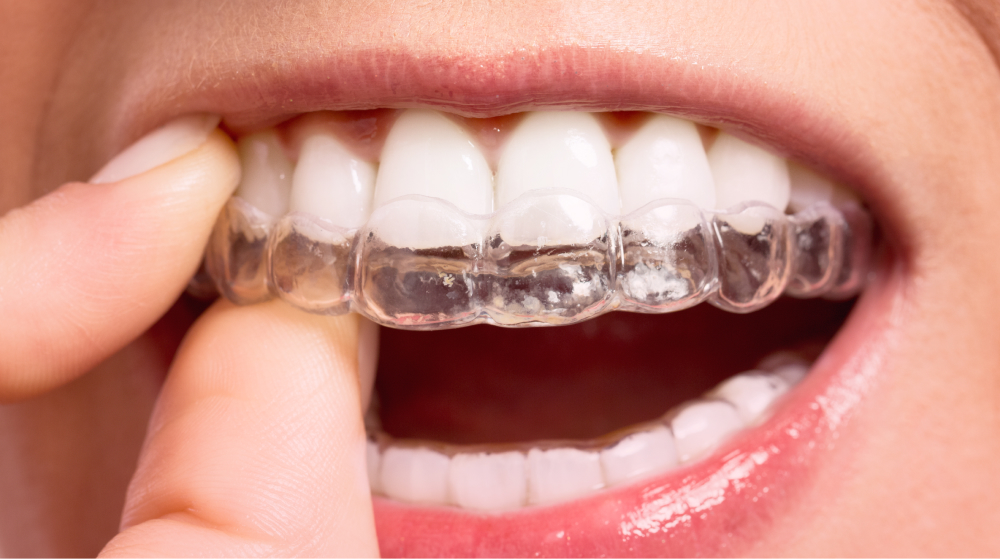 Durchsichtige Aligner-Zahnschienen